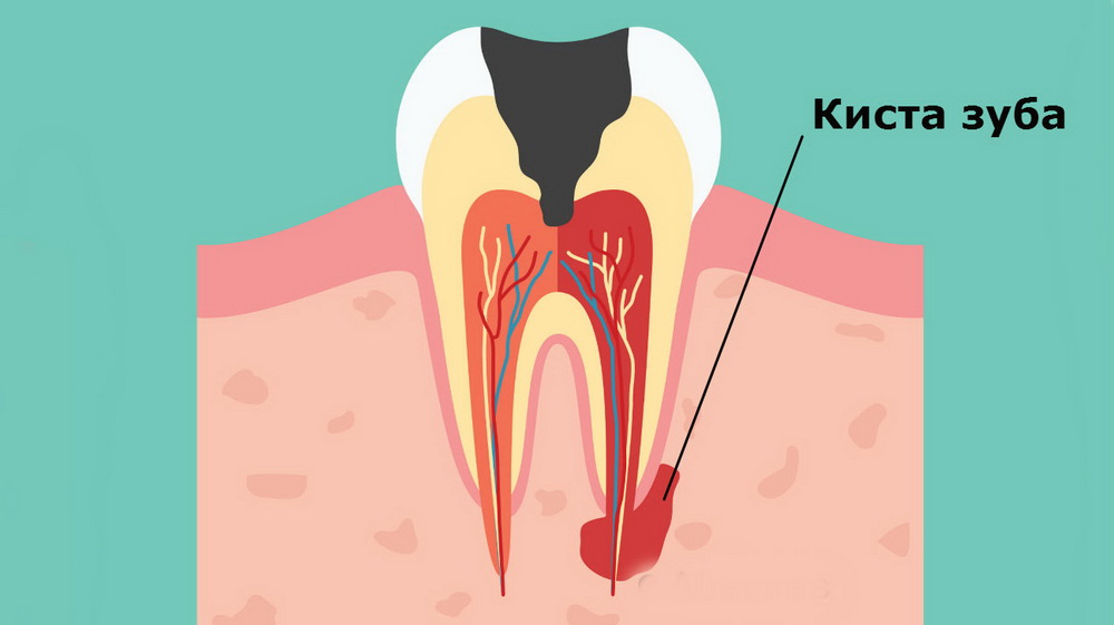 Киста зуба: причины, стадии, симптомы, виды и лечение кисты