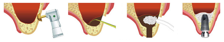 sinus